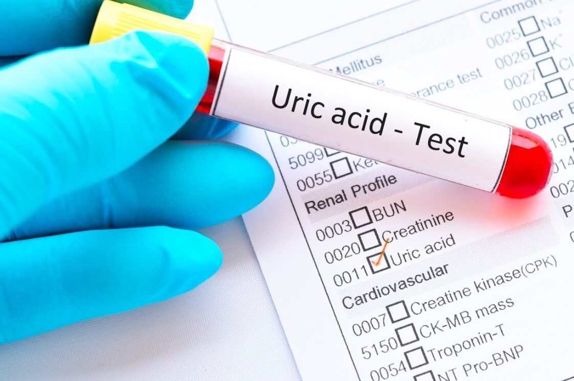 5 nguyên nhân khiến acid uric trong máu cao 1