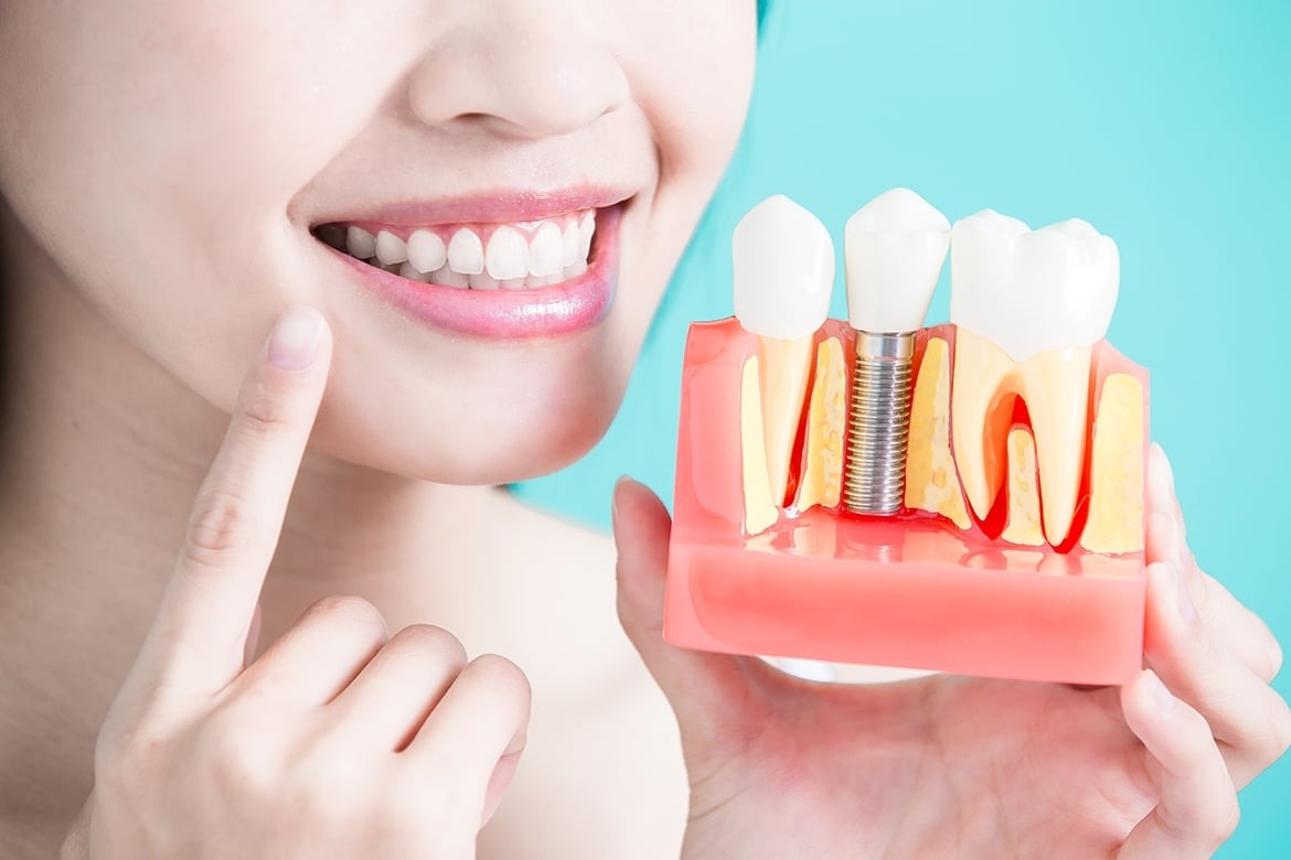 Top 4 sai lầm khi trồng răng implant 1