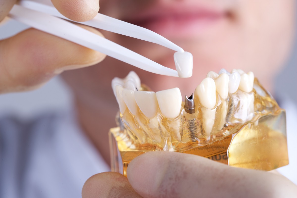 Top 4 sai lầm khi trồng răng implant 2