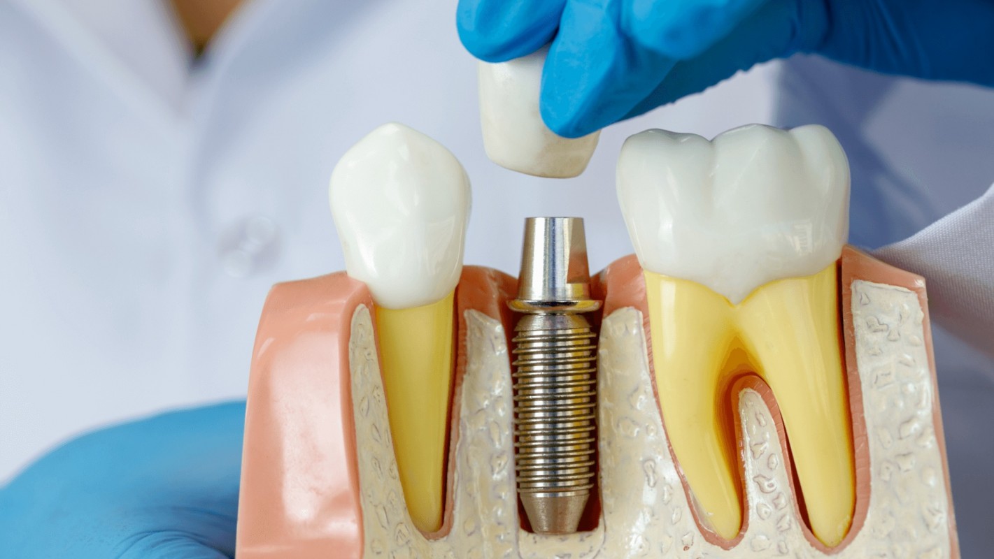 Top 4 sai lầm khi trồng răng implant 3