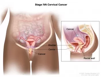 Cách điều trị ung thư cổ tử cung