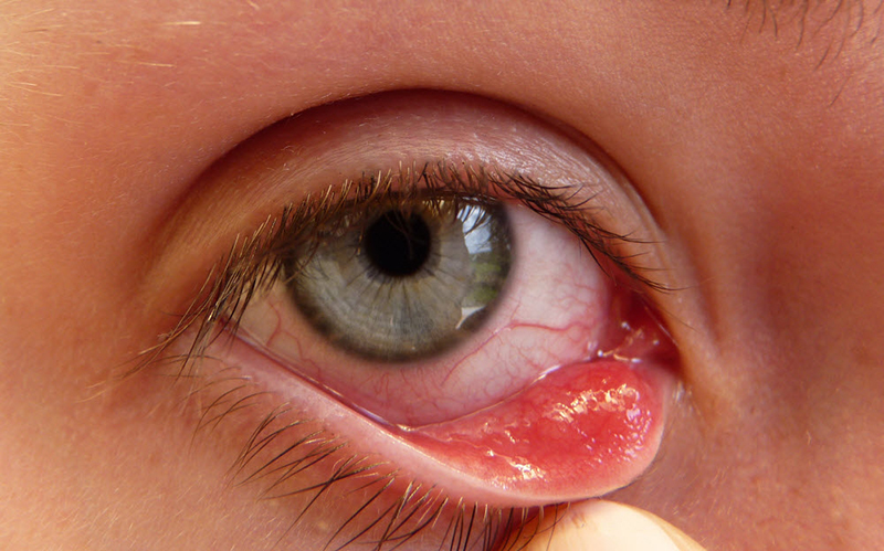 5 bệnh về mắt thường gặp và biện pháp khắc phục 2