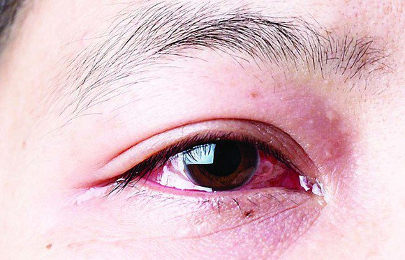 5 bệnh về mắt thường gặp và biện pháp khắc phục 3