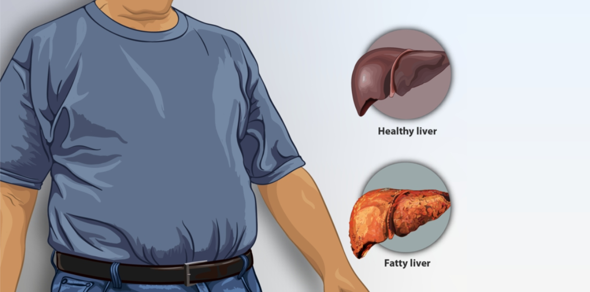 5 cách tự nhiên chữa gan nhiễm mỡ tại nhà 1