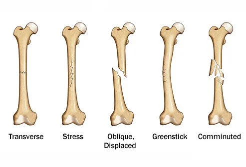 Bảy nguyên nhân khiến đau nhức xương 1