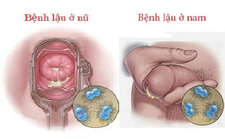 Bệnh lậu Điều trị dễ dàng nhàng đừng chủ quan 1