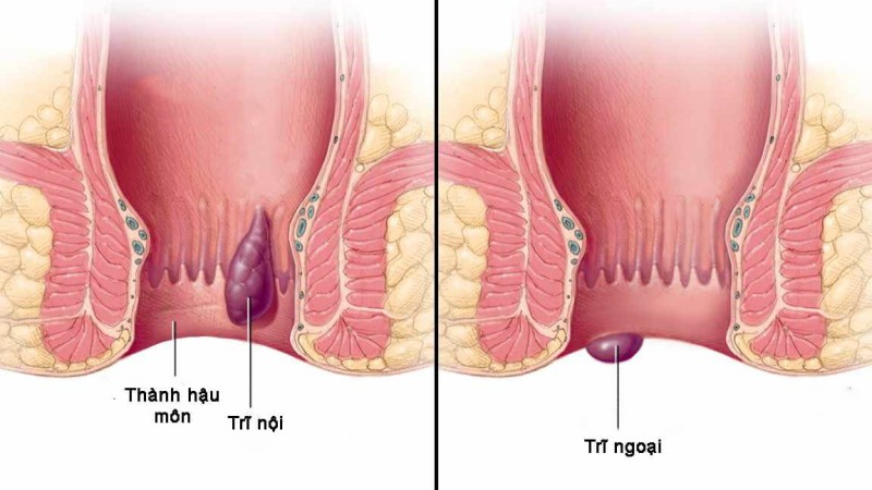 Bệnh trĩ và thói quen để phòng chống bệnh 1