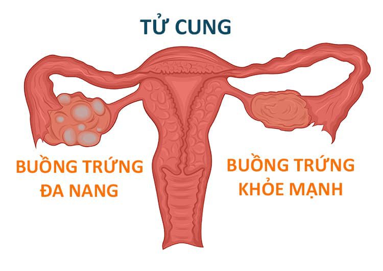 Buồng trứng đa nang là gì? Dấu hiệu buồng trứng đa nang và cách chữa trị