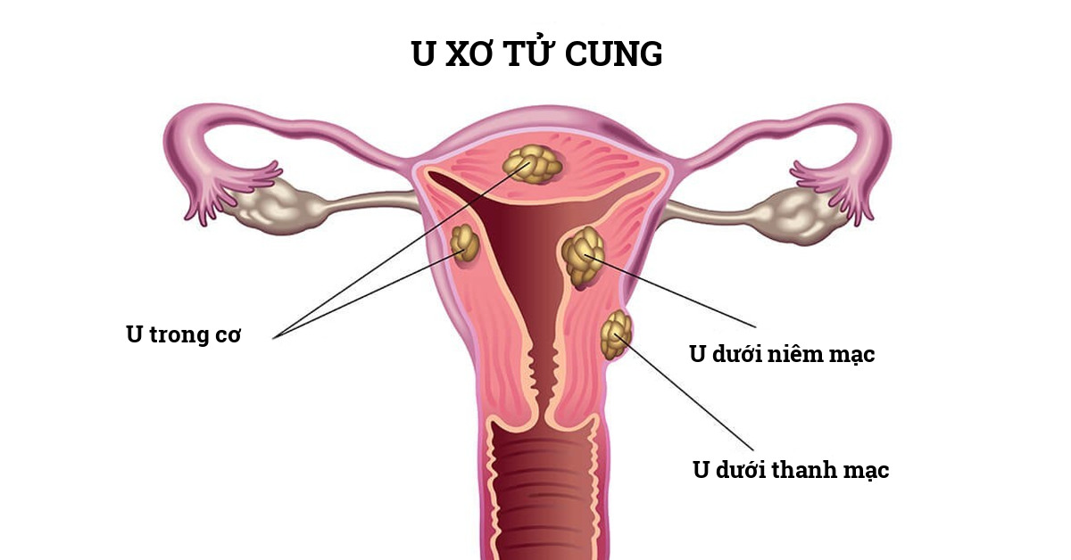 Các bệnh phụ khoa thường gặp ảnh hưởng đến khả năng sinh sản 2