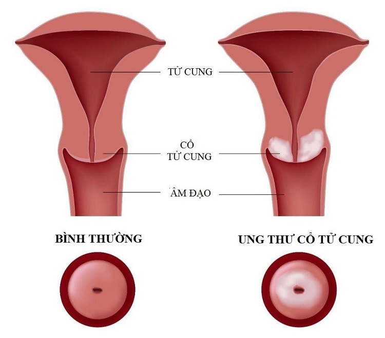 Các bệnh phụ khoa thường gặp ảnh hưởng đến khả năng sinh sản 4