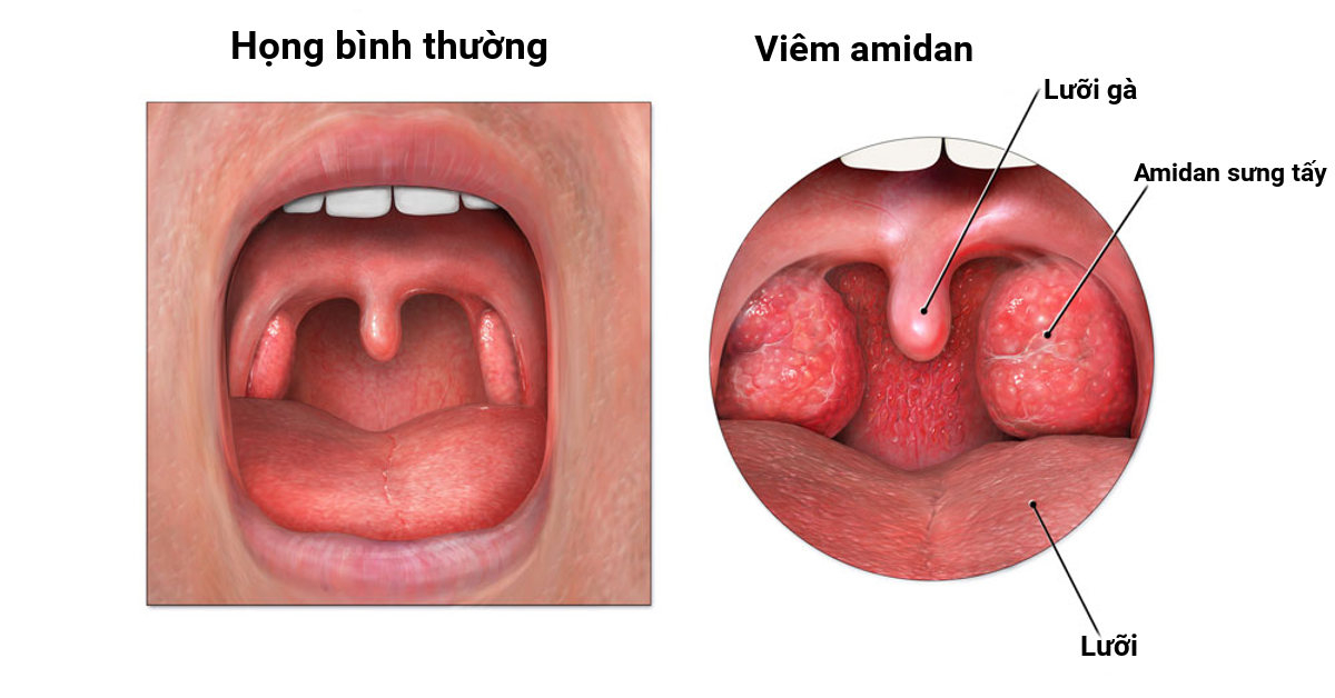 Có nên cắt amidan không và cách chữa amidan tại nhà 1