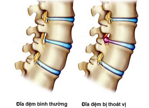 Điều trị đau vùng thắt lưng và đau thần kinh tọa do thoát vị đĩa đệm như thế nào 1