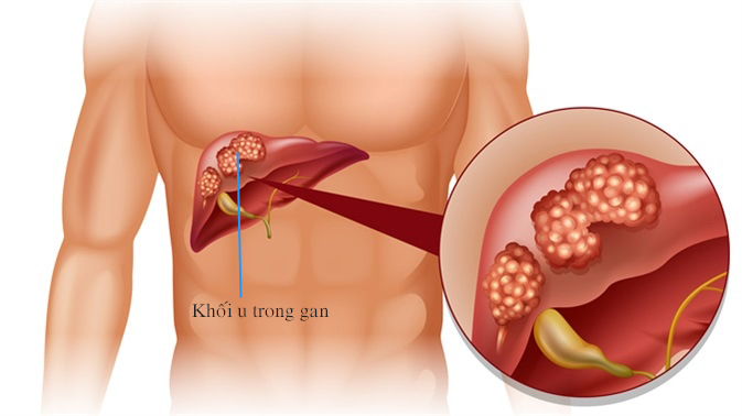 Làm thế nào để ngăn ngừa ung thư gan 2