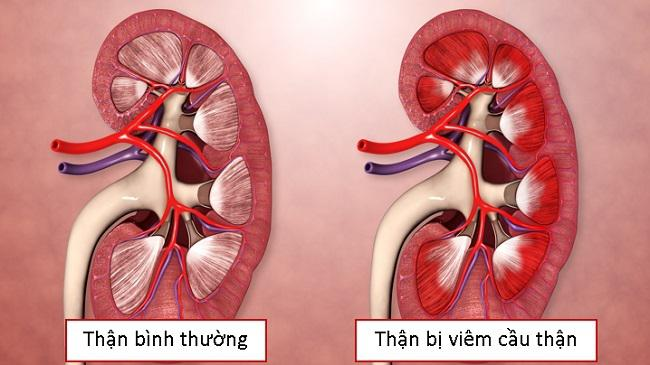 Những triệu chứng thường gặp ở bệnh nhân viêm cầu thận 1