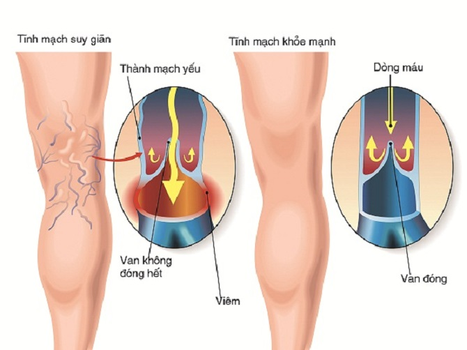 Suy giảm tĩnh mạch là gì Dấu hiệu và cách phòng ngừa 1