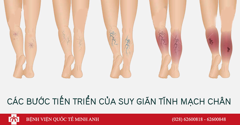 Suy giảm tĩnh mạch là gì Dấu hiệu và cách phòng ngừa 2