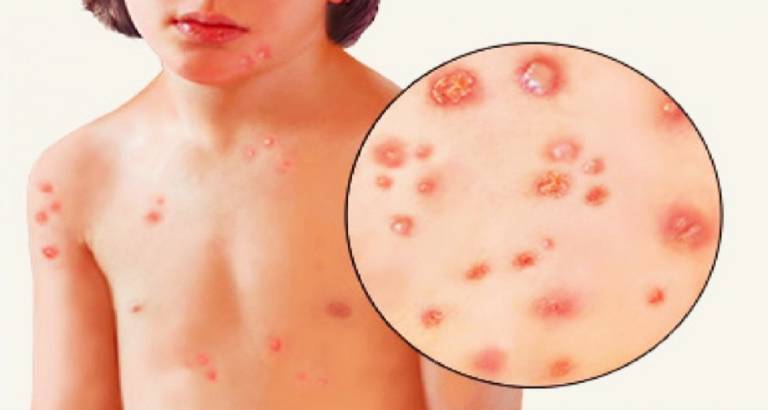 Nguy hiểm khôn lường từ bệnh Pemphigus