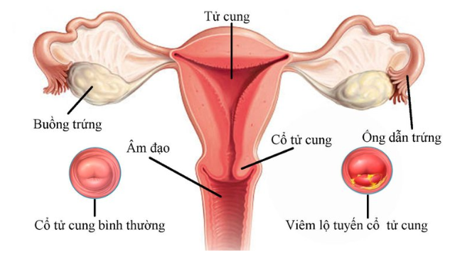 VIÊM LỘ TUYẾN CỔ TỬ CUNG