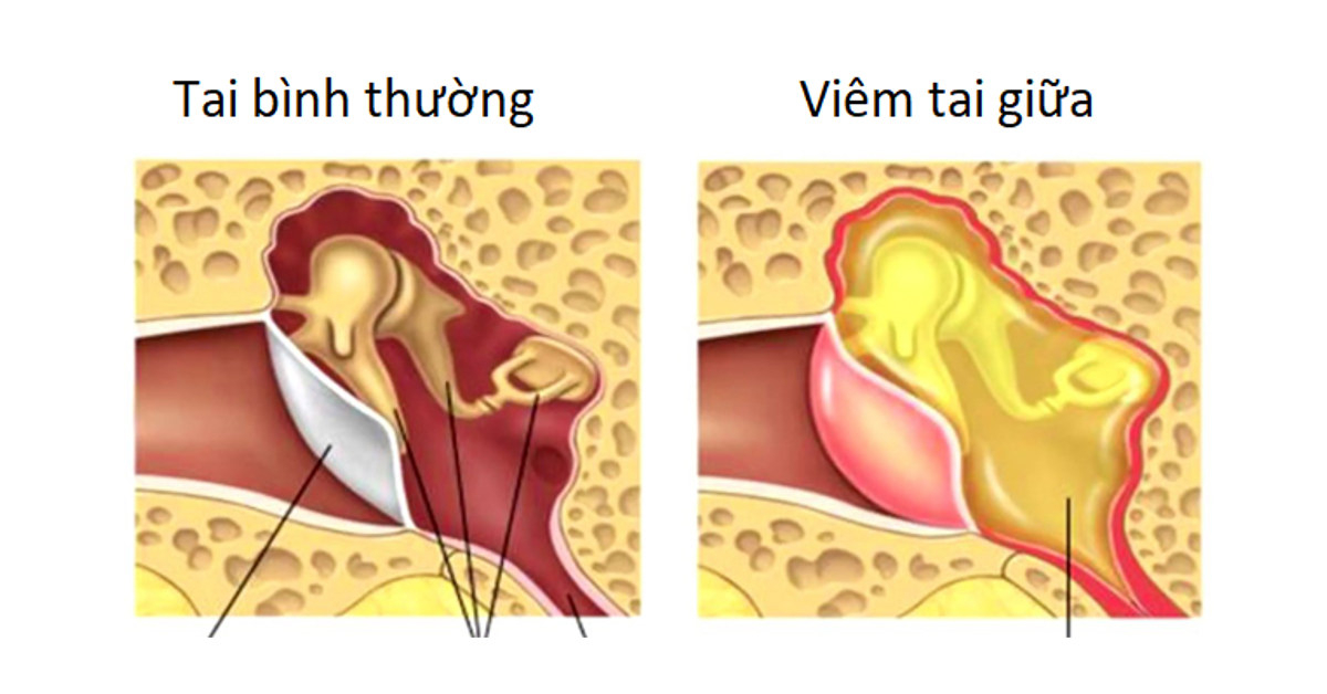 Các bệnh tai mũi họng thường gặp và cách phòng bệnh 2