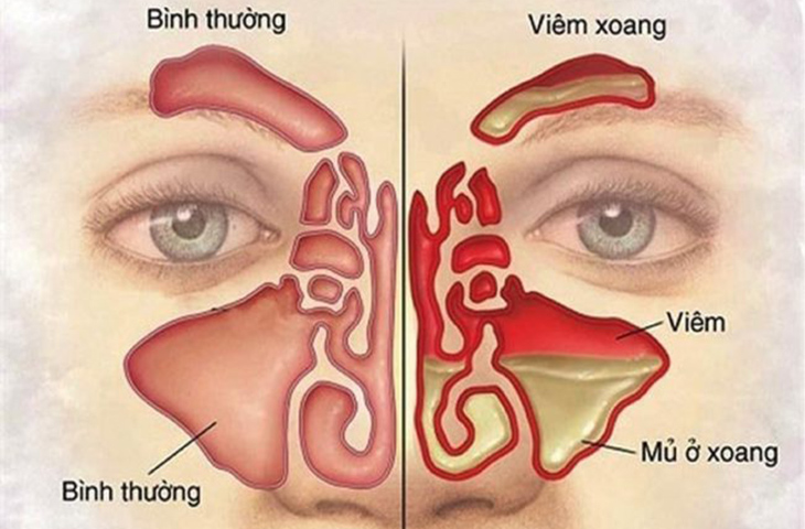 Các bệnh tai mũi họng thường gặp và cách phòng bệnh 3