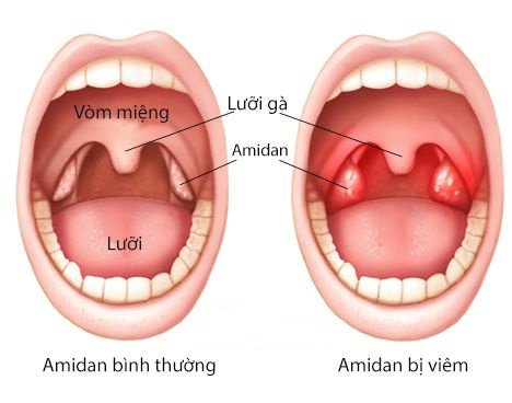 Các bệnh tai mũi họng thường gặp và cách phòng bệnh 4