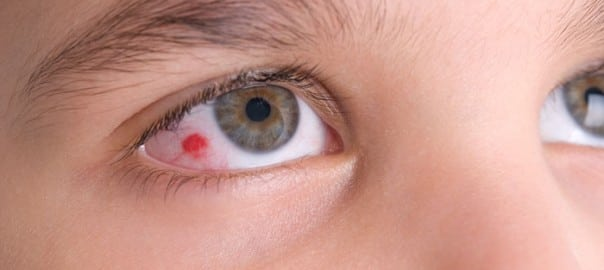 Nguyên nhân làm đau mắt đỏ ở trẻ nhỏ 1