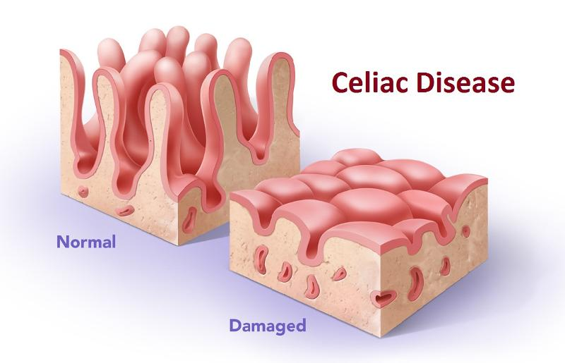 Bệnh Celiac 1
