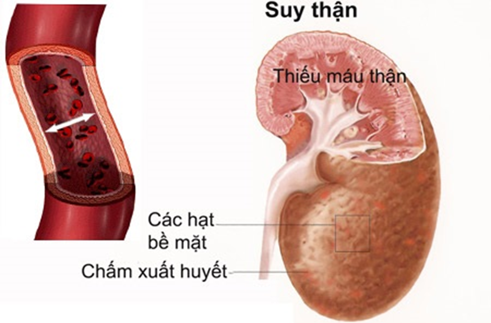 SỰ NGUY HIỂM CỦA HỘI CHỨNG SUY TẾ BÀO 1