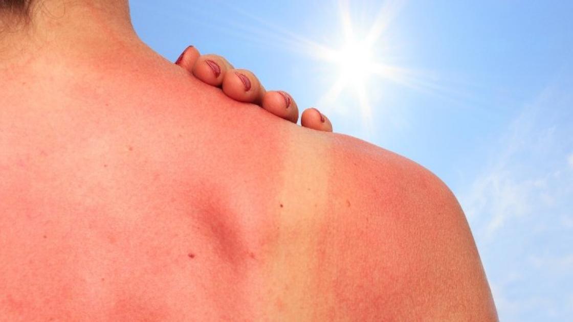 Cách bảo vệ da khi đi biển du lịch vào mùa hè 3