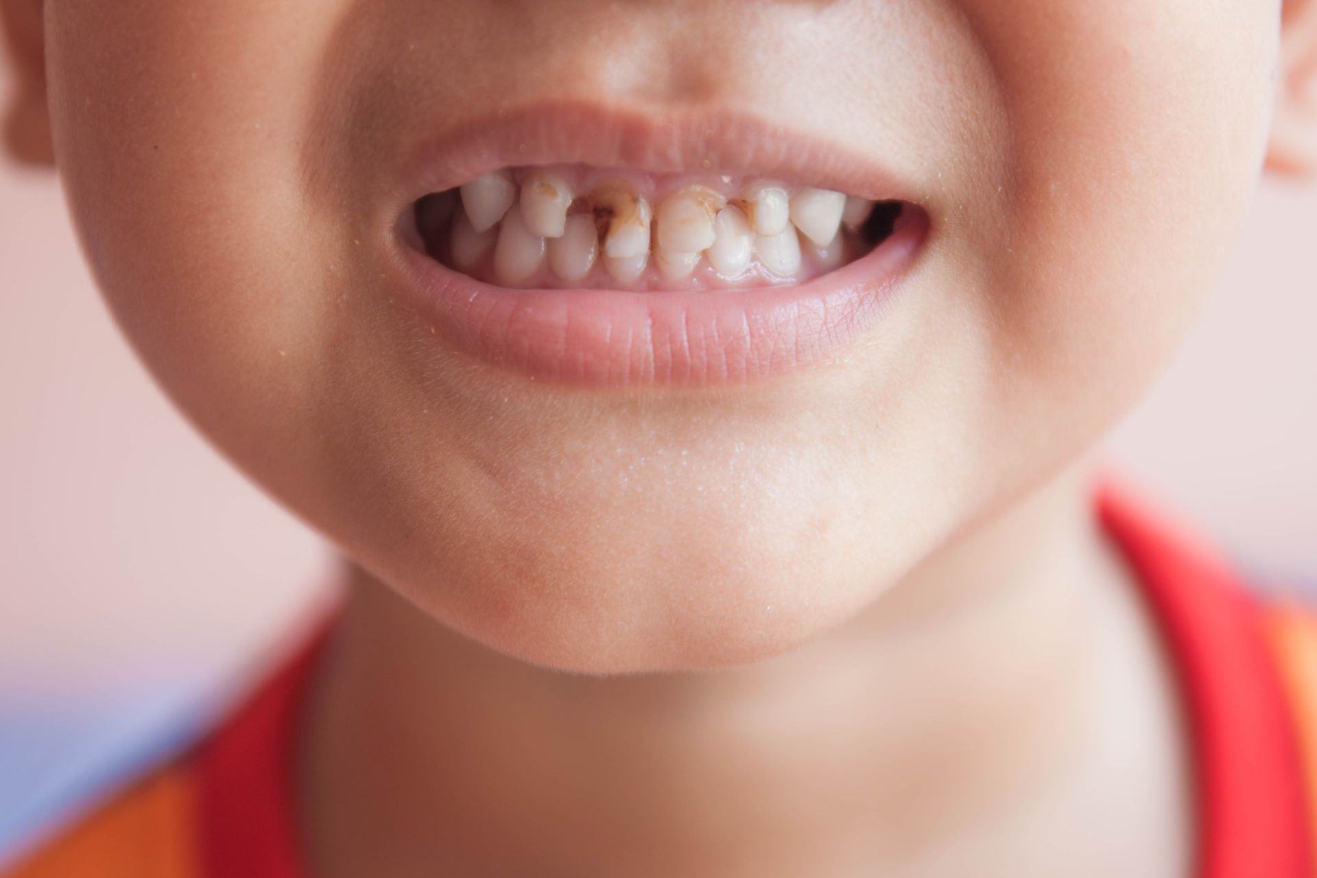 Cách trị tận gốc nguyên nhân gây sâu răng ở trẻ 1