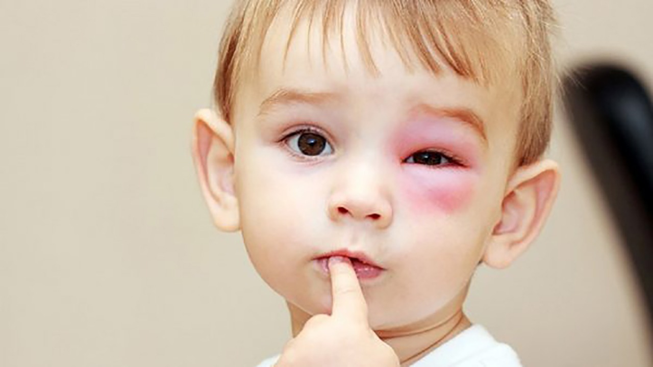 Cảnh báo dịch đau mắt đỏ ở trẻ em kèm theo nhiều biến chứng 1