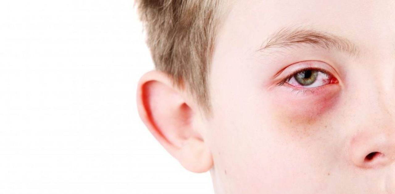 Cảnh báo dịch đau mắt đỏ ở trẻ em kèm theo nhiều biến chứng 2