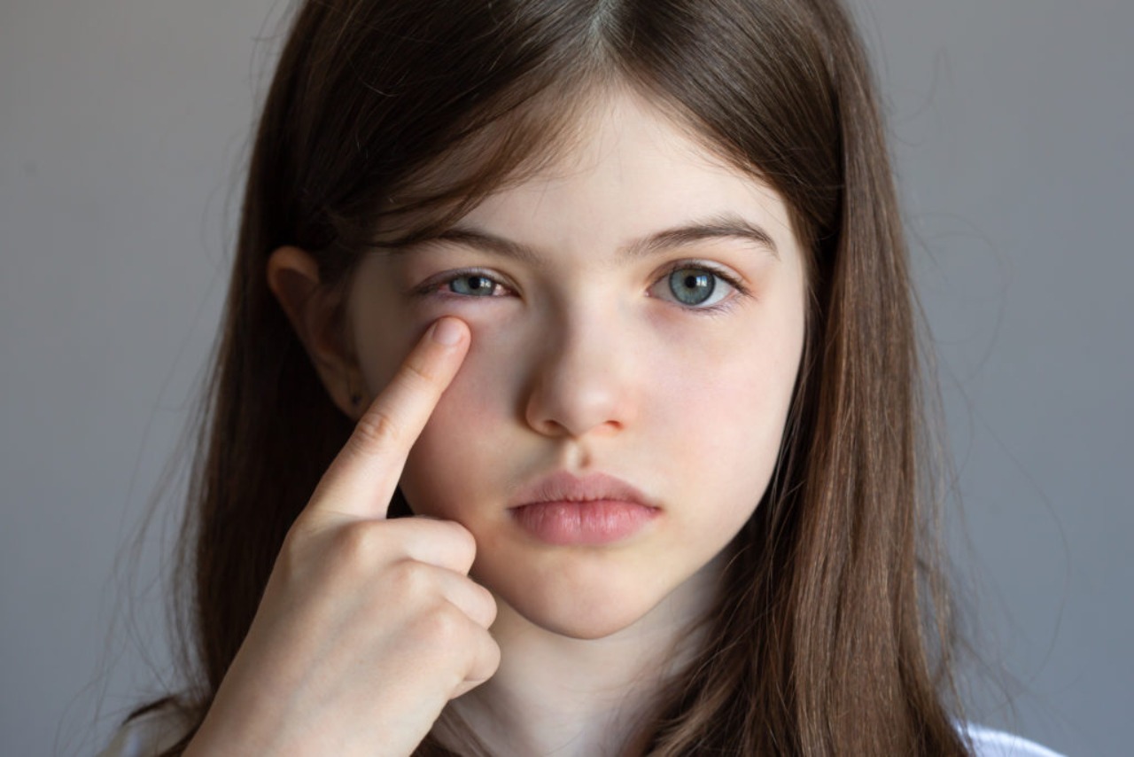 Cảnh báo dịch đau mắt đỏ ở trẻ em kèm theo nhiều biến chứng 3