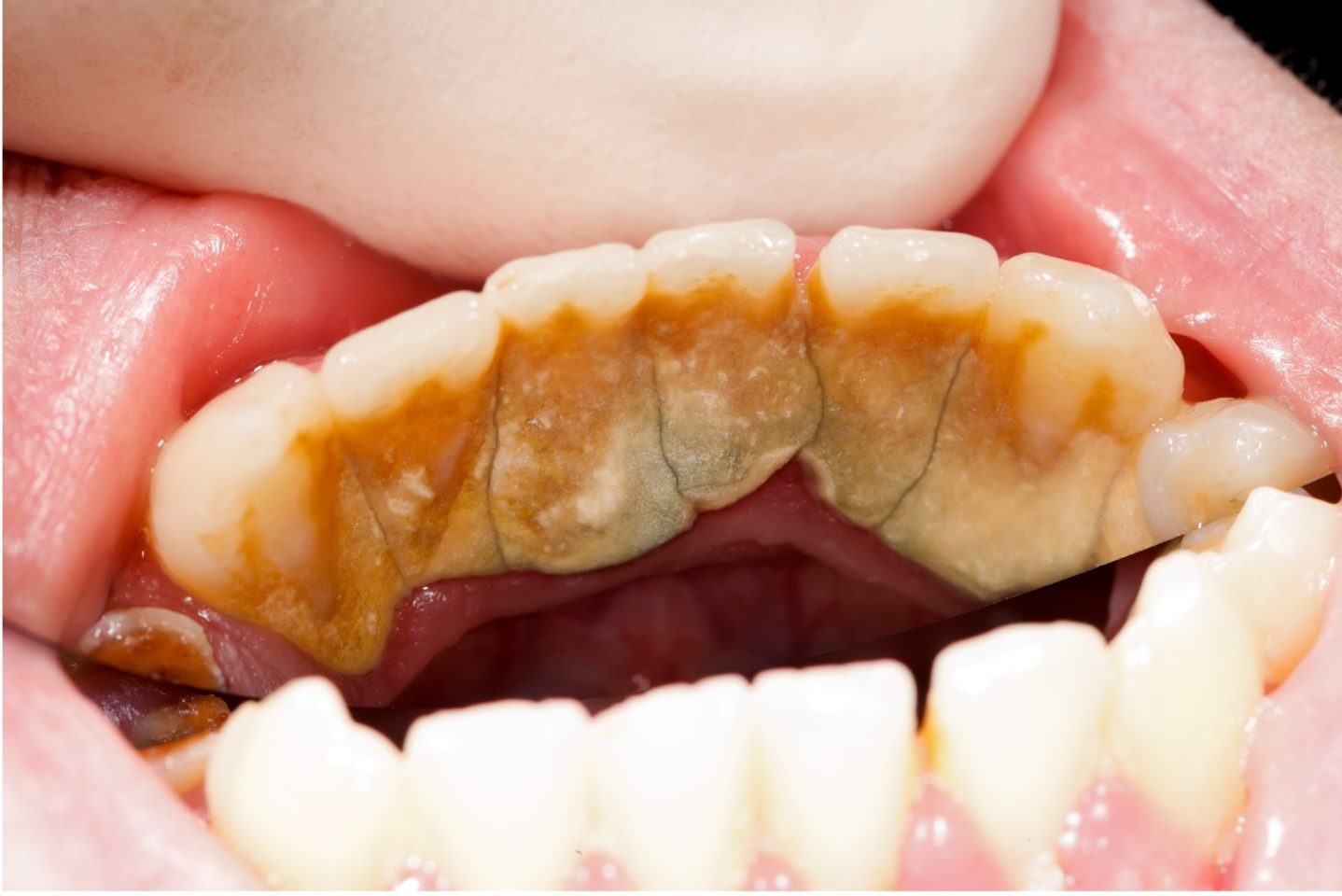 Cao răng lâu ngày làm rụng răng 3