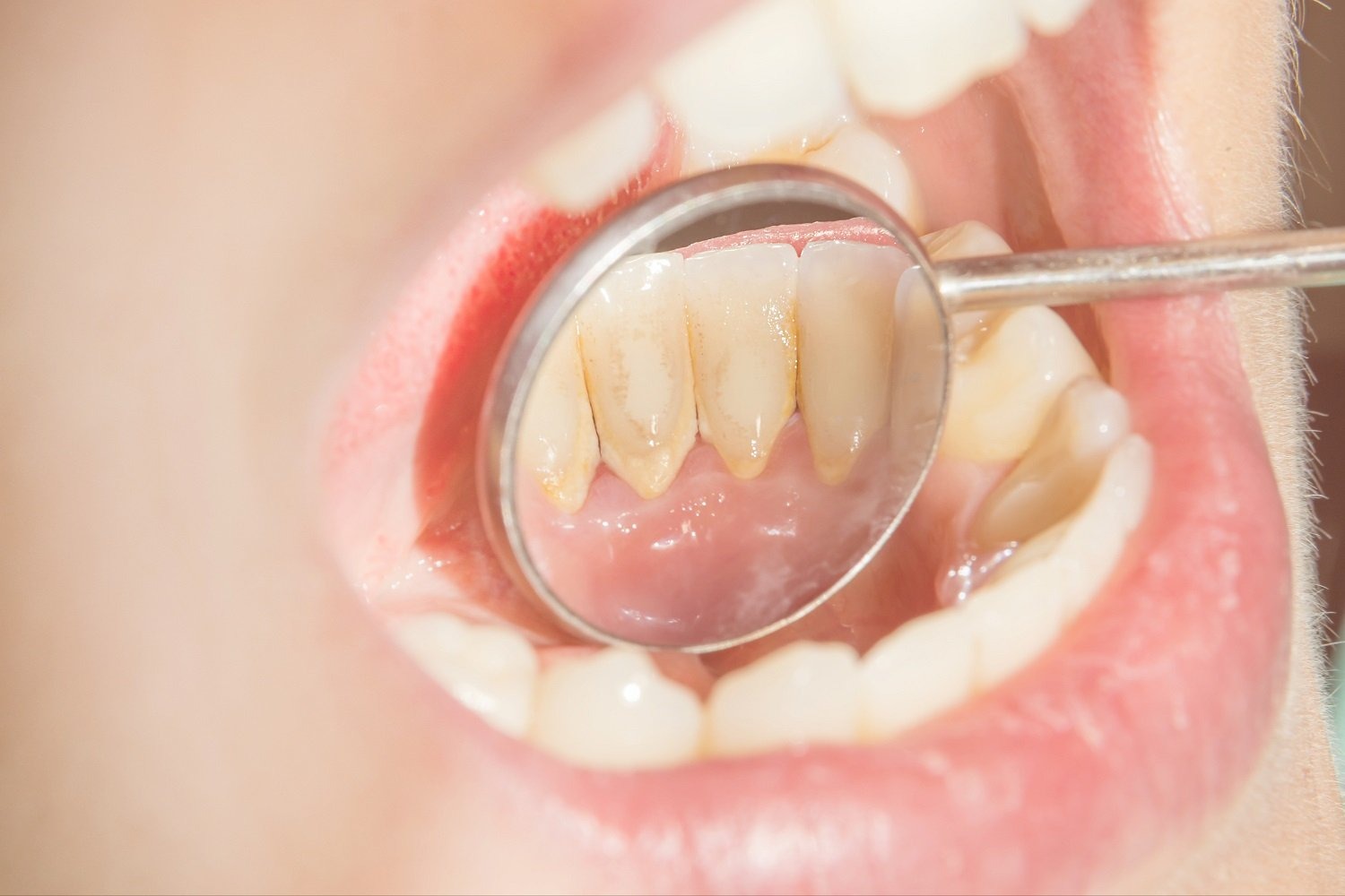 Cao răng lâu ngày làm rụng răng 4