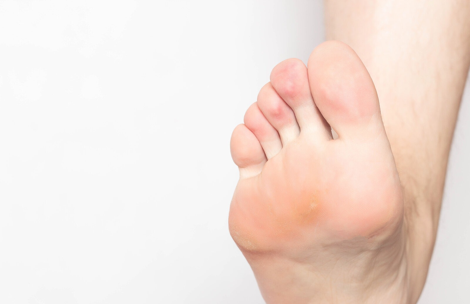 Tại sao chai chân cần được phát hiện và điều trị sớm 1
