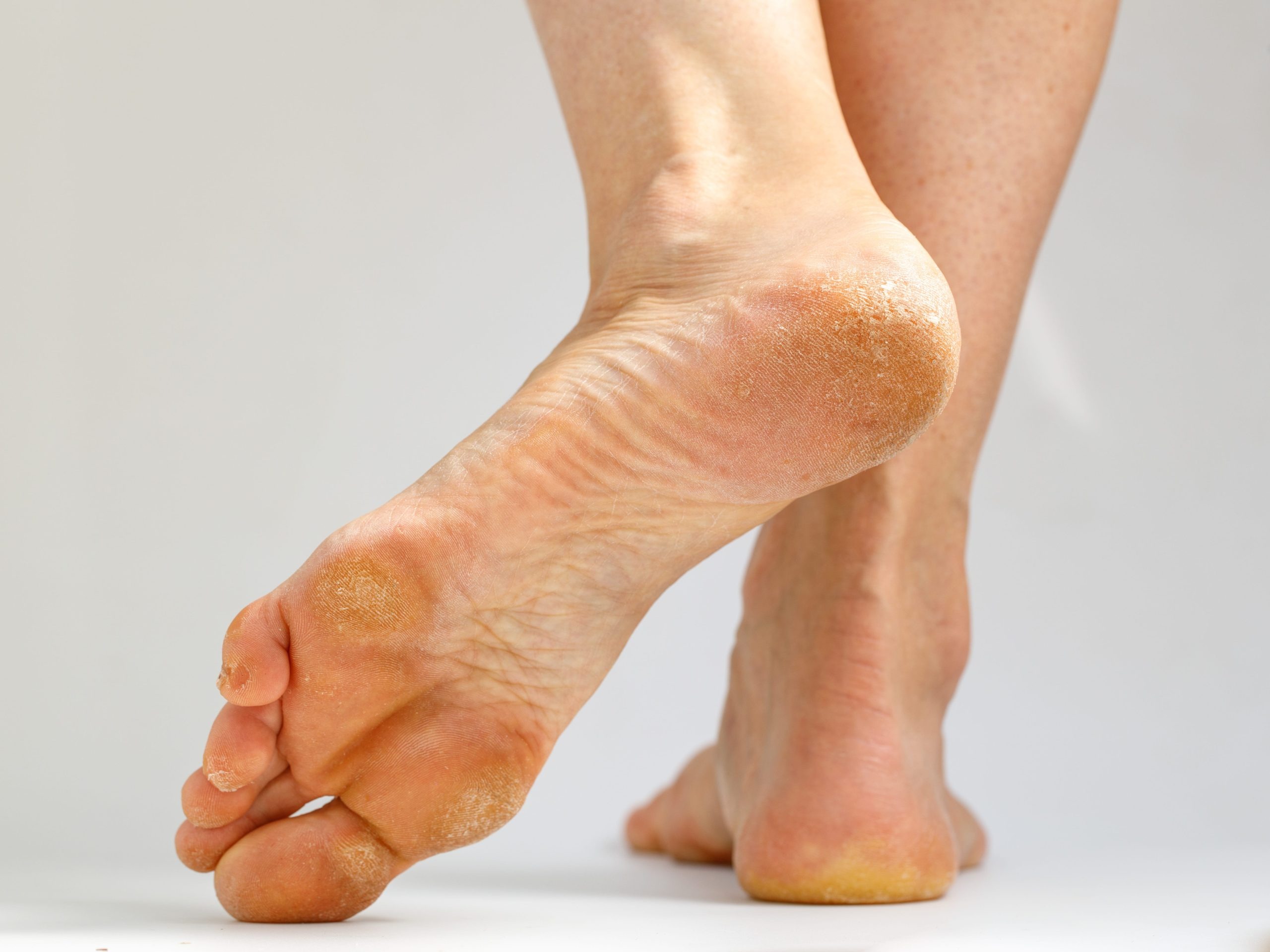 Tại sao chai chân cần được phát hiện và điều trị sớm 2
