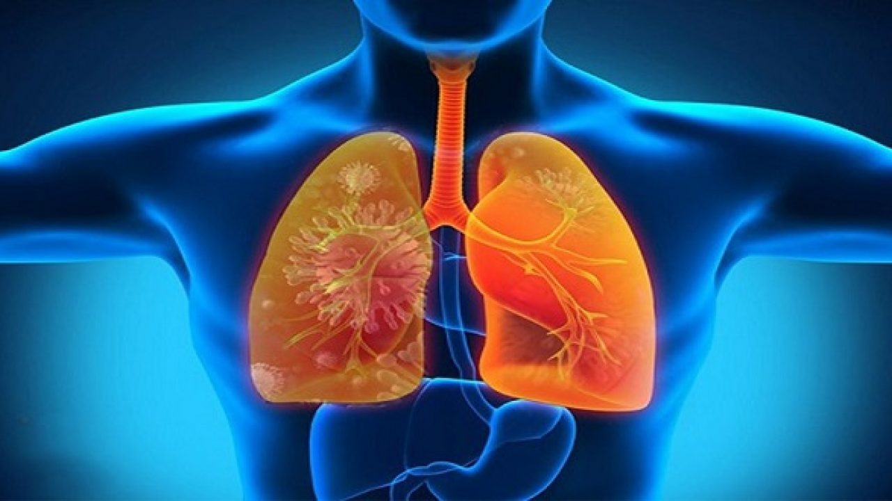 tuyệt đối không chủ quan với bệnh viêm phổi 1