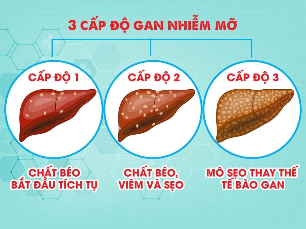 Bệnh gan nhiễm mỡ có chữa khỏi được không 2