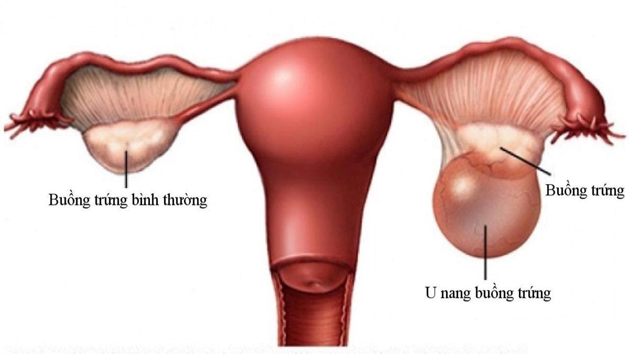 Những chị em nào có nguy cơ cao bị u nang buồng trứng 1