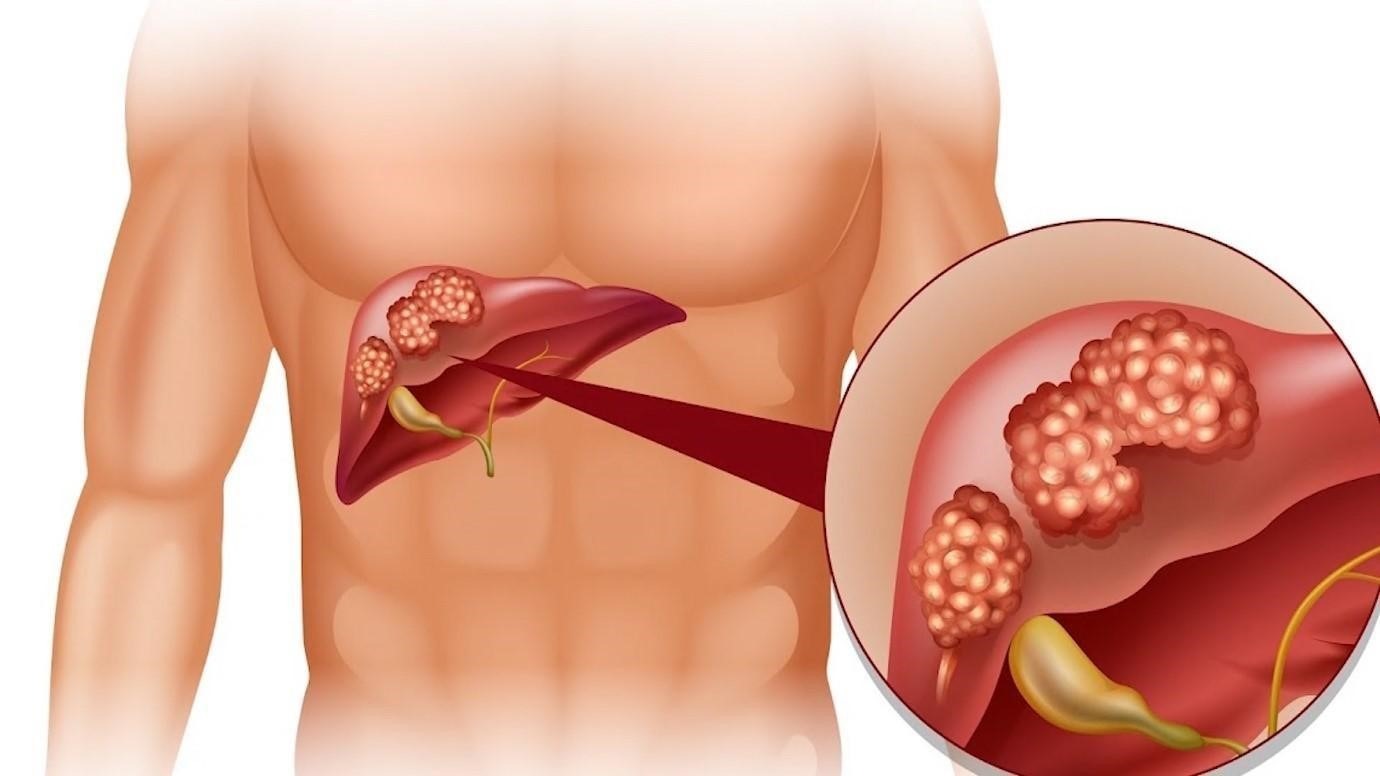 Những sai lầm phổ biến khi thải độc gan 2