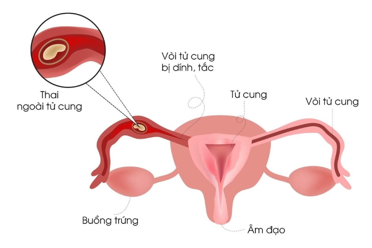 Cảnh Báo Sớm Chửa Ngoài Tử Cung Và Nguy Hiểm Tiềm Ẩn 3