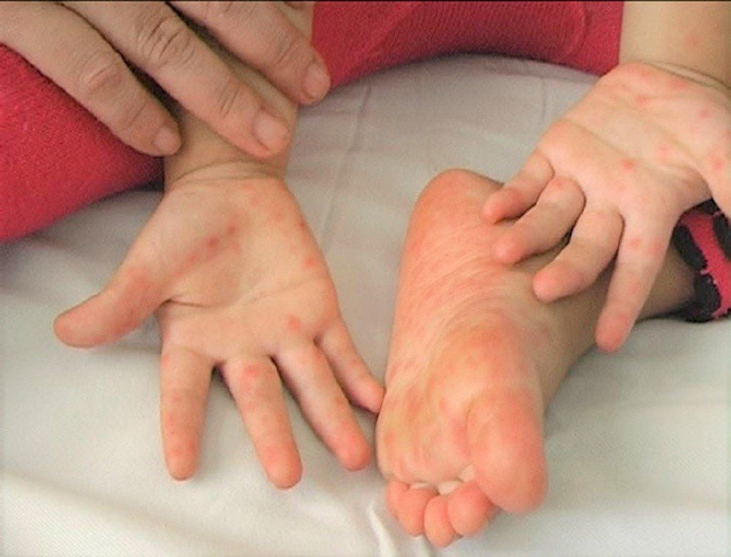 Cảnh Báo Bệnh Tay Chân Miệng Tăng Nhanh Ở Trẻ Em: Dấu Hiệu Nhận Biết & Cách Phòng Ngừa
