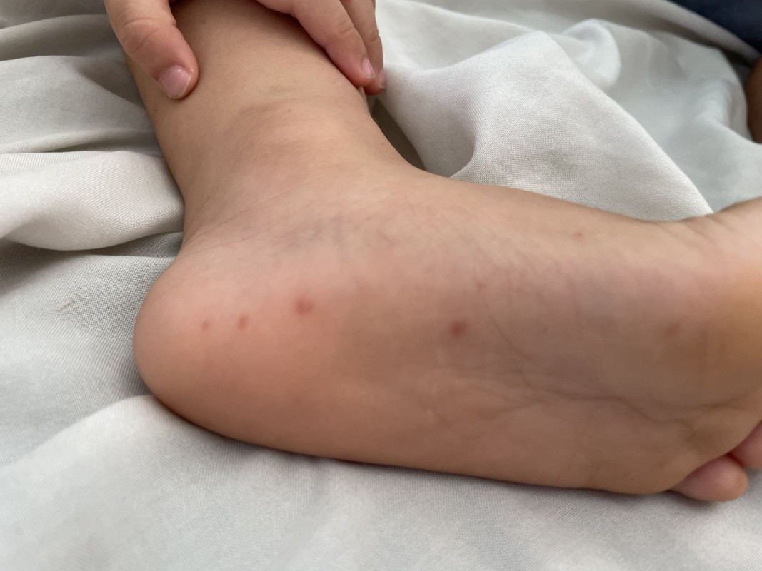Cảnh Báo Bệnh Tay Chân Miệng Tăng Nhanh Ở Trẻ Em 2