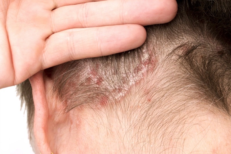 Dầu Gội Kém Chất Lượng Gây Rụng Tóc Nghiêm Trọng 1