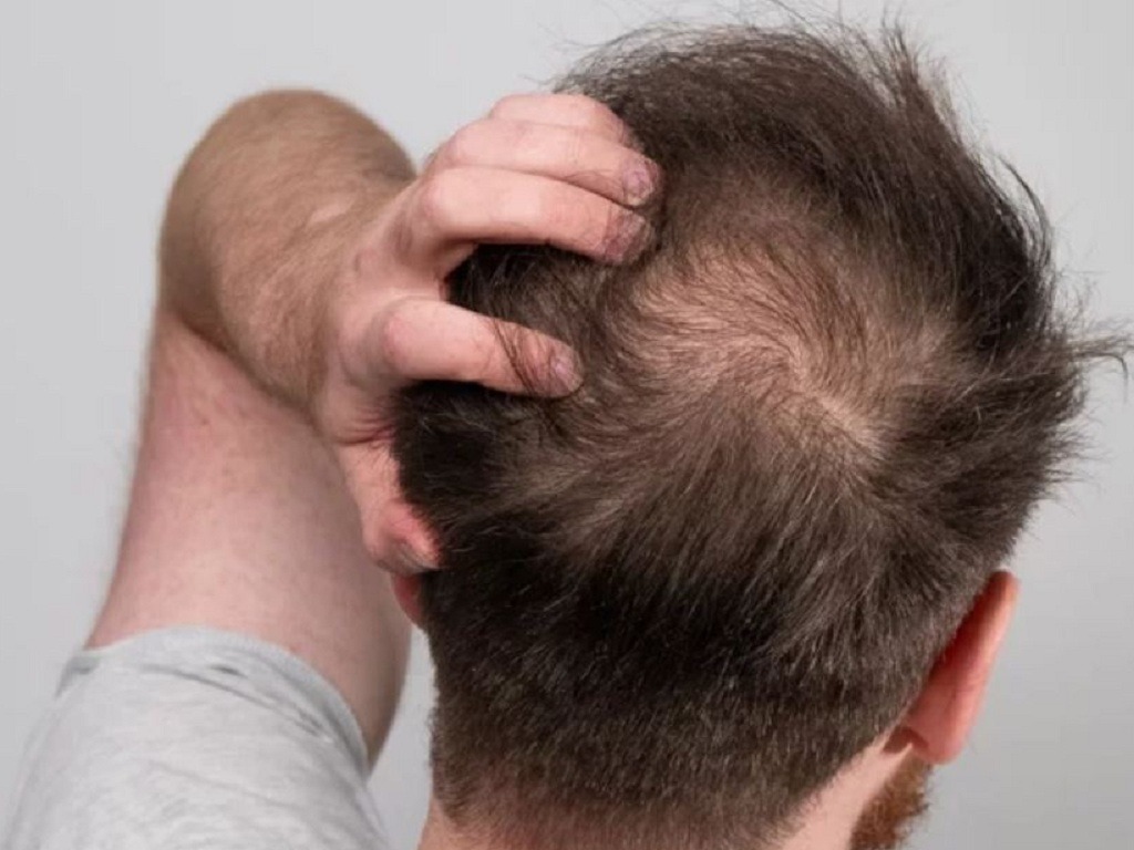 Lạm dụng thuốc mọc tóc 2