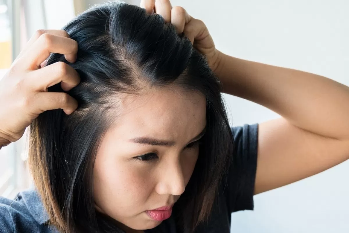 Rụng tóc từng mảng – Dấu hiệu thầm lặng của bệnh tuyến giáp?